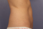 CoolSculpting® Before and after photo