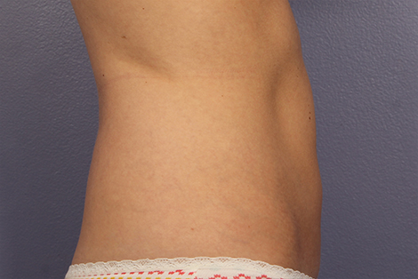 CoolSculpting® before and after photo