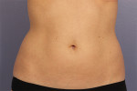 CoolSculpting® Before and after photo