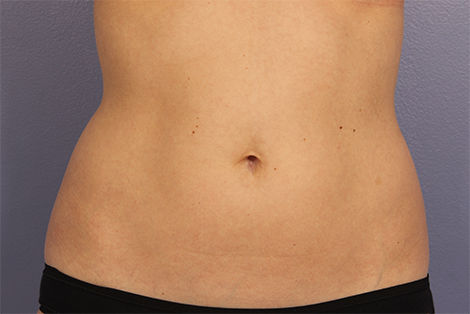 CoolSculpting® before and after photo