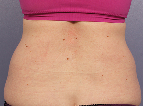 CoolSculpting® before and after photo