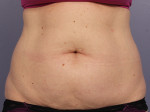 CoolSculpting® Before and after photo