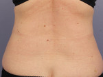 CoolSculpting® Before and after photo