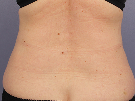 CoolSculpting® before and after photo