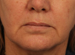 Injectable Fillers Before and after photo