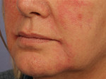 Injectable Fillers Before and after photo