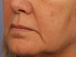 Injectable Fillers Before and after photo