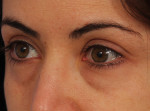 Injectable Fillers Before and after photo