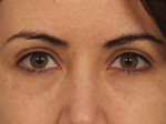 Injectable Fillers Before and after photo