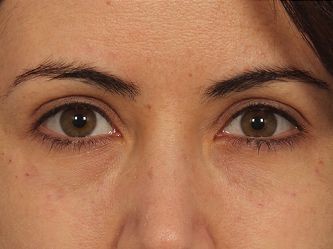 Injectable Fillers before and after photo