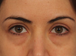 Injectable Fillers Before and after photo