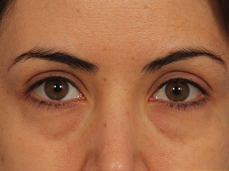 Injectable Fillers before and after photo