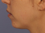 Injectable Fillers Before and after photo