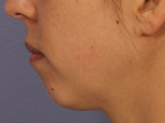 Injectable Fillers Before and after photo