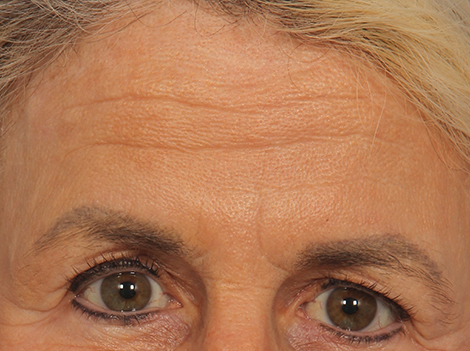 BOTOX® Cosmetic before and after photo