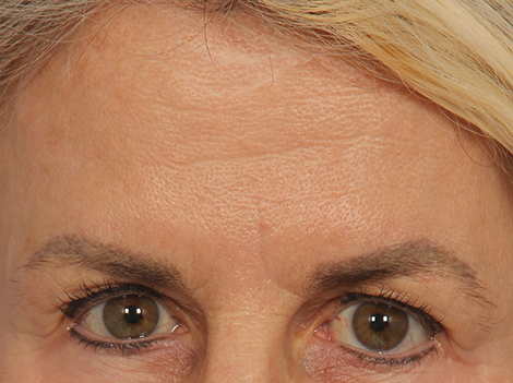 BOTOX® Cosmetic before and after photo