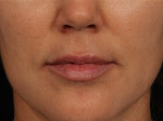 Injectable Fillers Before and after photo