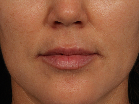 Injectable Fillers before and after photo