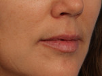 Injectable Fillers Before and after photo