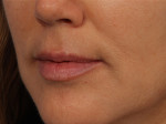 Injectable Fillers Before and after photo