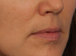 Injectable Fillers Before and after photo