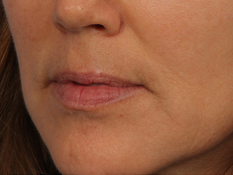 Injectable Fillers before and after photo