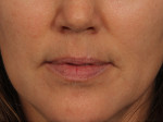 Injectable Fillers Before and after photo