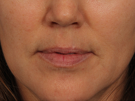 Injectable Fillers before and after photo