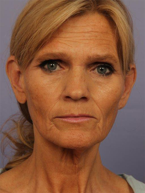 Facelift before and after photo