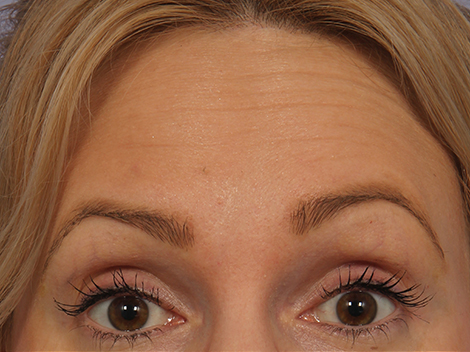 Wrinkle Reduction before and after photo