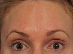 Wrinkle Reduction Before and after photo