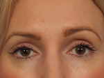 Wrinkle Reduction Before and after photo