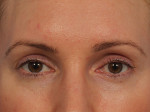 Wrinkle Reduction Before and after photo