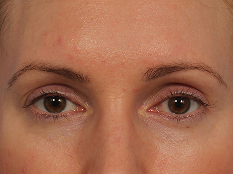 Wrinkle Reduction before and after photo