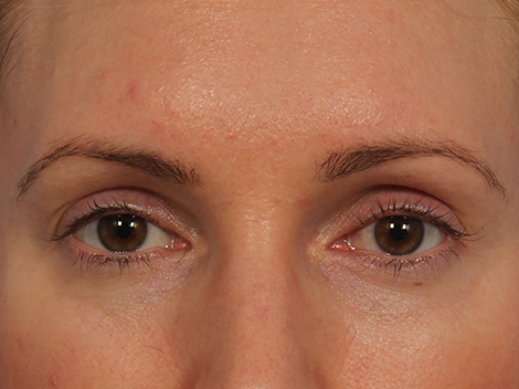 Wrinkle Reduction before and after photo