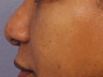 Injectable Fillers Before and after photo