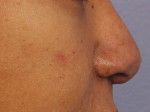 Injectable Fillers Before and after photo