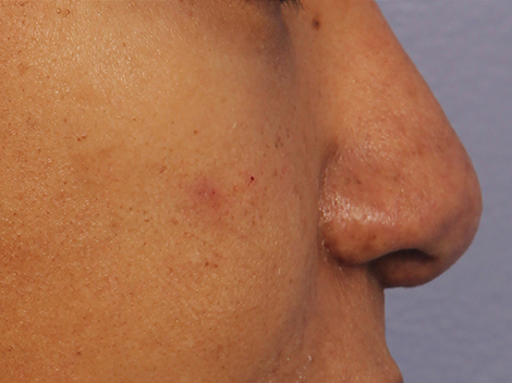 Injectable Fillers before and after photo