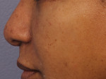 Injectable Fillers Before and after photo