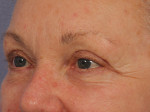 Injectable Fillers Before and after photo