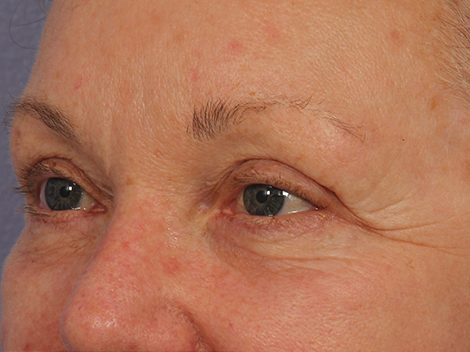 Injectable Fillers before and after photo