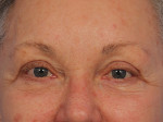 Injectable Fillers Before and after photo