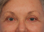 Injectable Fillers Before and after photo