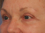 Injectable Fillers Before and after photo