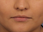 Injectable Fillers Before and after photo