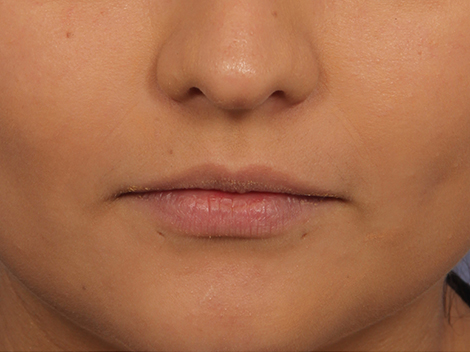 Injectable Fillers before and after photo