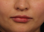 Injectable Fillers Before and after photo