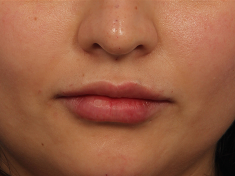 Injectable Fillers before and after photo