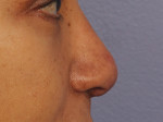 Injectable Fillers Before and after photo