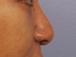 Injectable Fillers Before and after photo